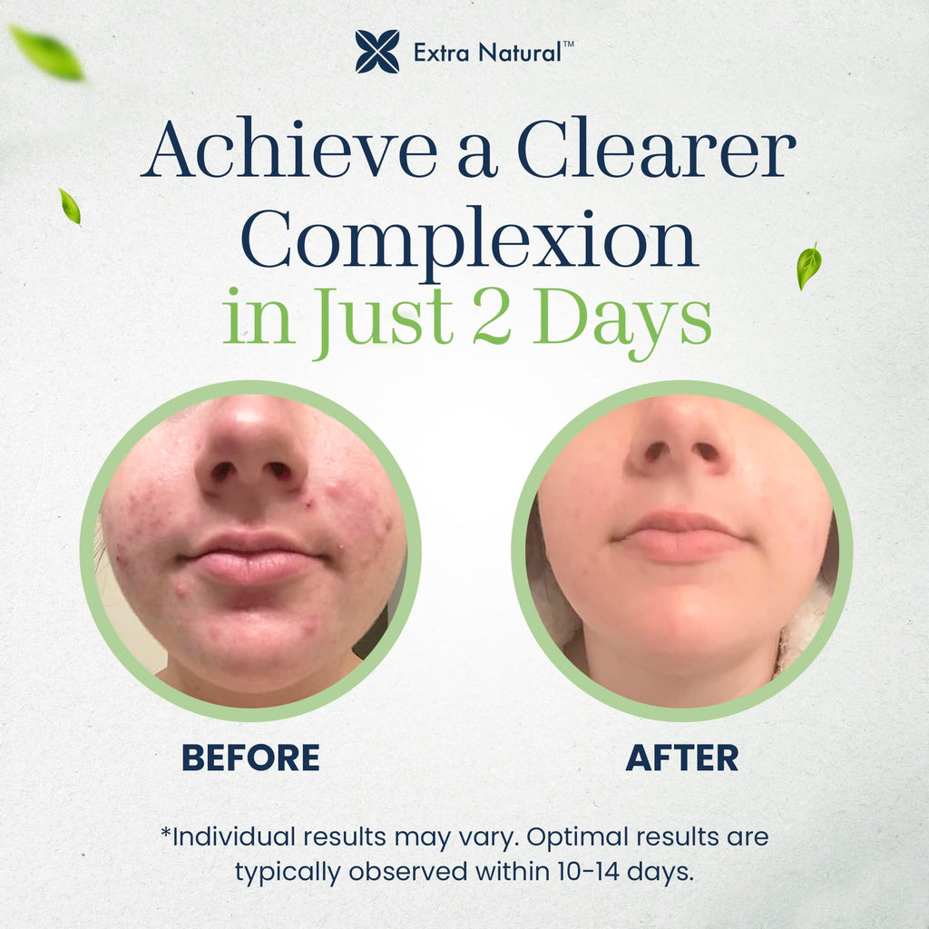 ExtraNatural Acne Cream – Gentle, Plant-Powered Care for Sensitive & Oily Skin