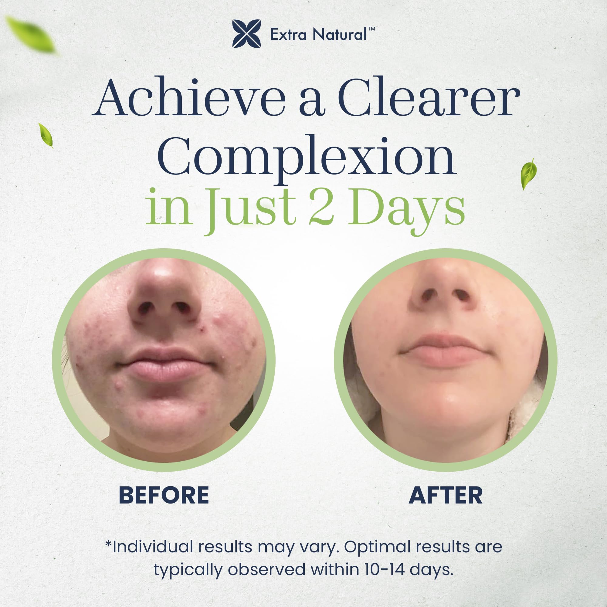 ExtraNatural Acne Cream – Gentle, Plant-Powered Care for Sensitive & Oily Skin