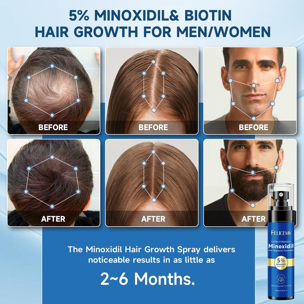 Felicemy 5% Minoxidil Spray for Hair & Beard Growth — Men & Women, 3.38 Fl Oz