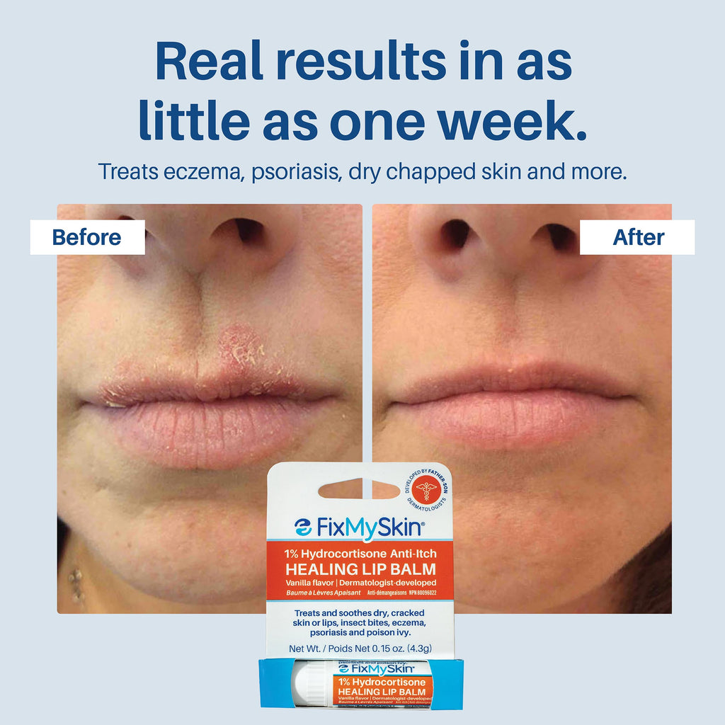 FixMySkin 1% Hydrocortisone Healing Lip Balm – Vanilla | Dermatologist-Developed & Travel-Friendly