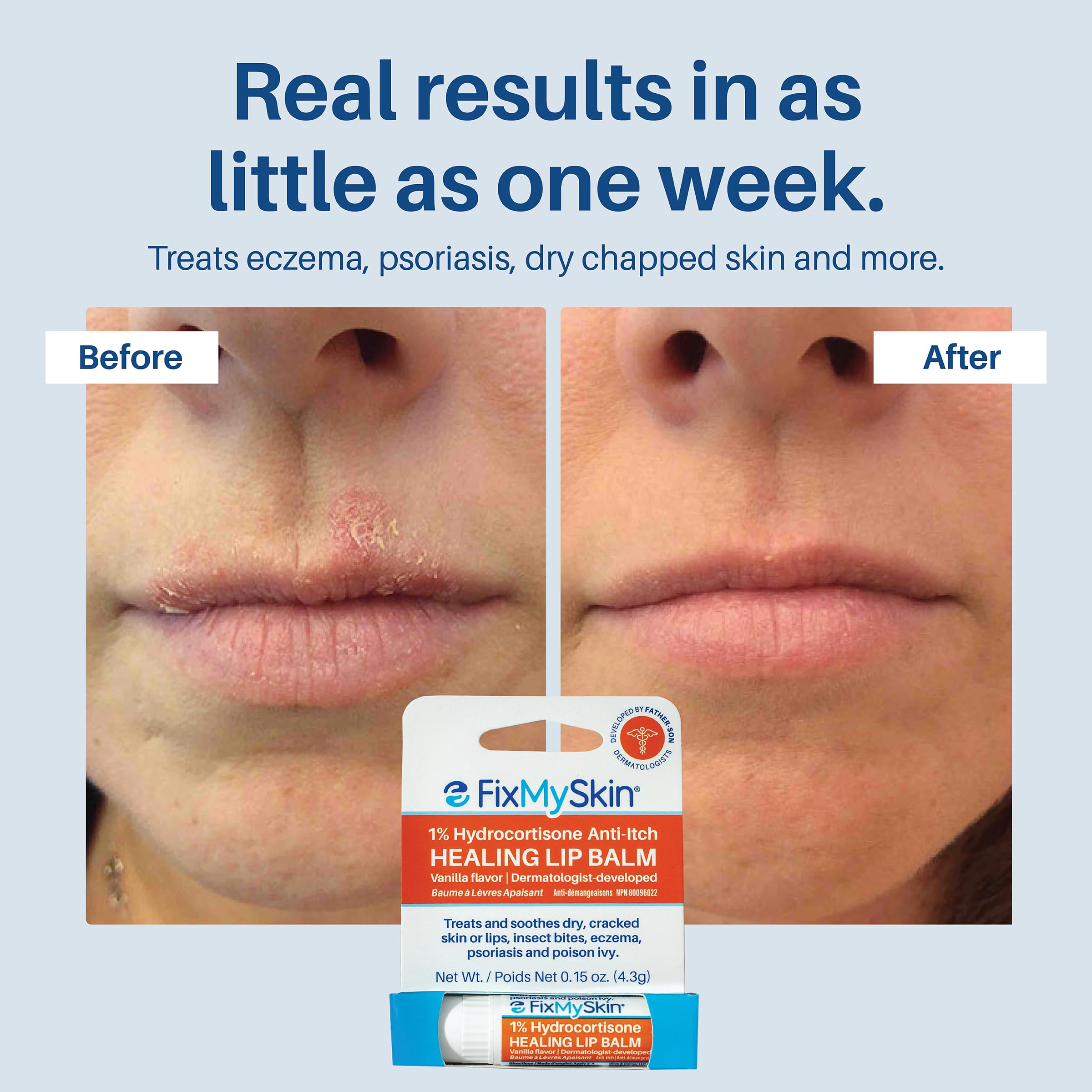 FixMySkin 1% Hydrocortisone Healing Lip Balm – Vanilla | Dermatologist-Developed & Travel-Friendly