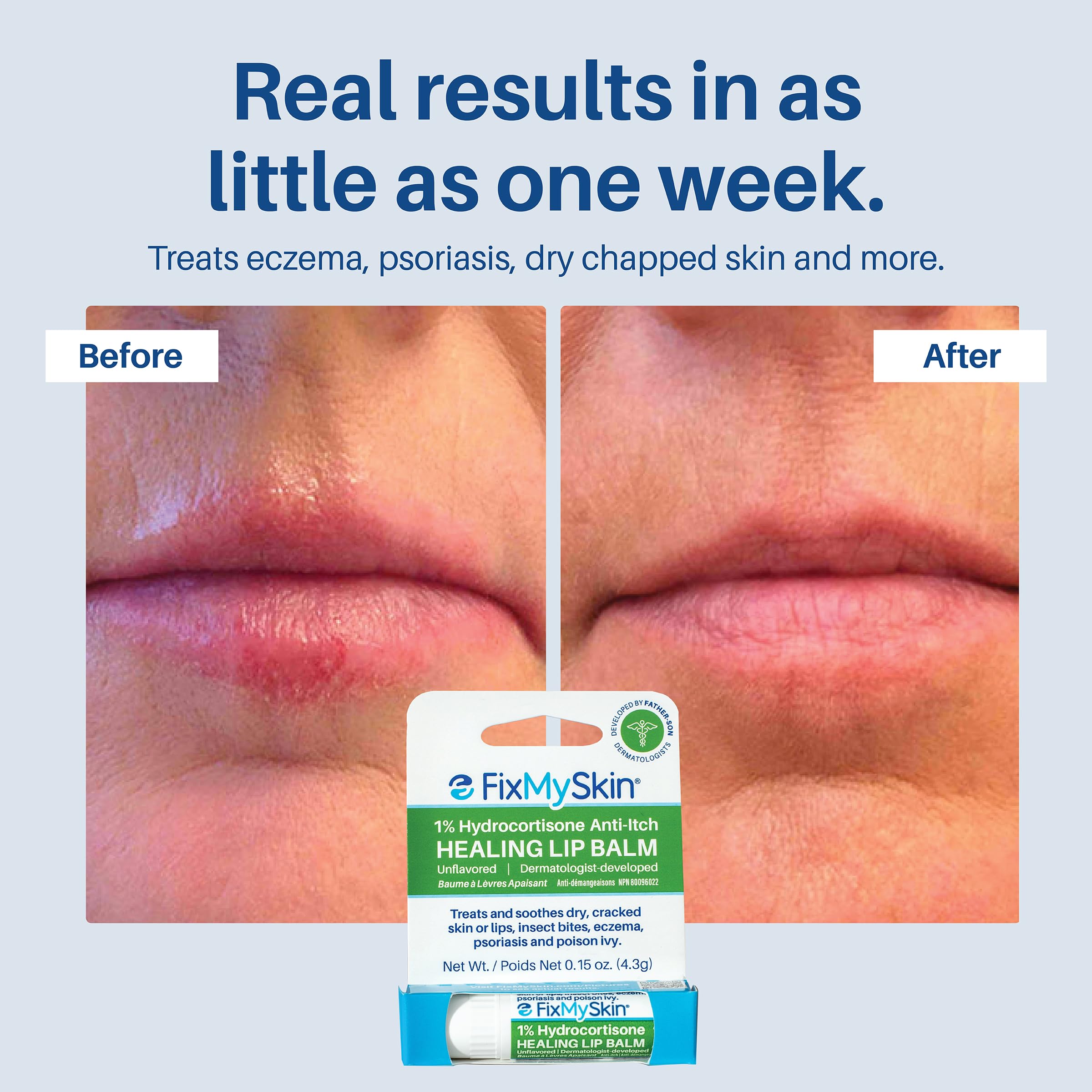 FixMySkin 1% Hydrocortisone Healing Lip Balm, Unflavored – 0.15 oz