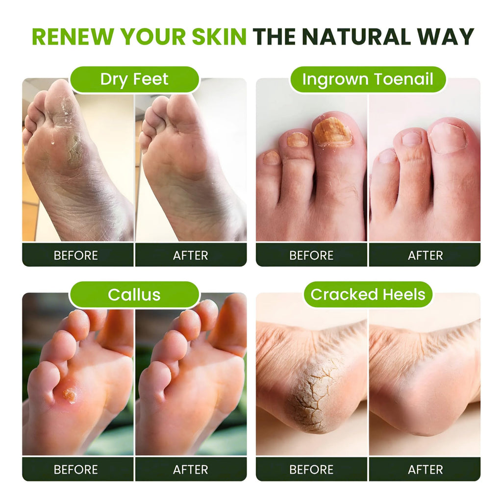 FOOT CURE Tea Tree Oil Foot Soak with Epsom Salt – Spa Foot Bath for Calluses, Odor & Tired Feet (Pack of 2)