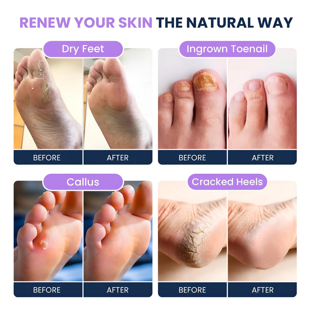 FOOT CURE Premium Epsom Salt Foot Soak with Tea Tree Oil — Pack of 4