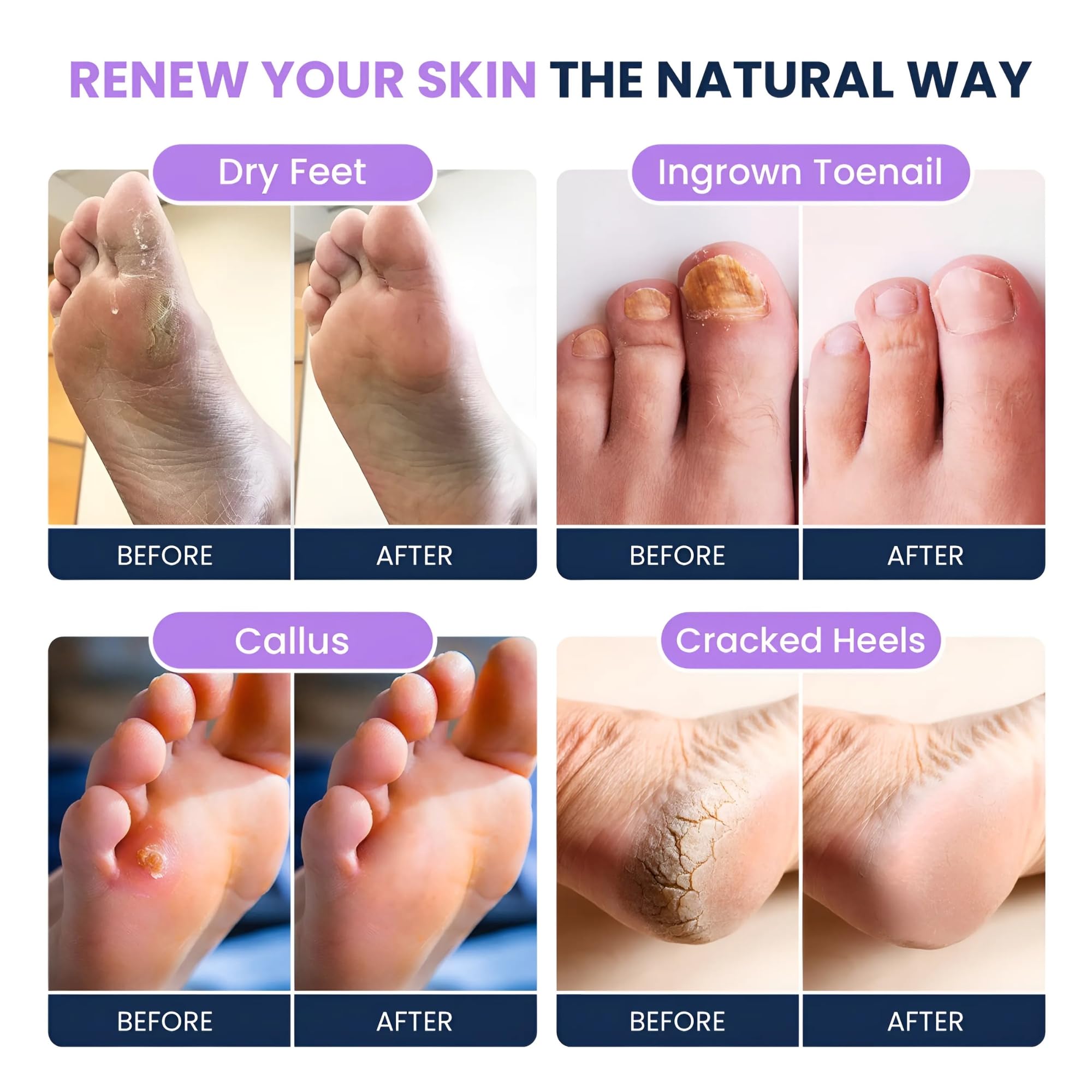 FOOT CURE Premium Epsom Salt Foot Soak with Tea Tree Oil — Pack of 4