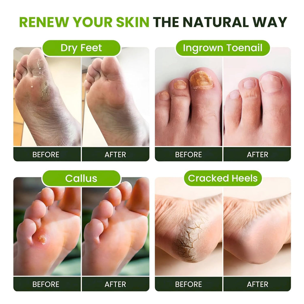 FOOT CURE Tea Tree Oil Foot Soak with Epsom Salts – Pack of 4 for Foot Comfort, Odor & Calluses