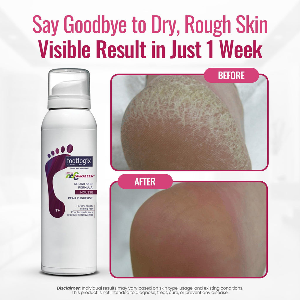 Footlogix Rough Skin Formula with Spiraleen Mousse – Dry Cracked Heels & Feet Care, 4.23oz