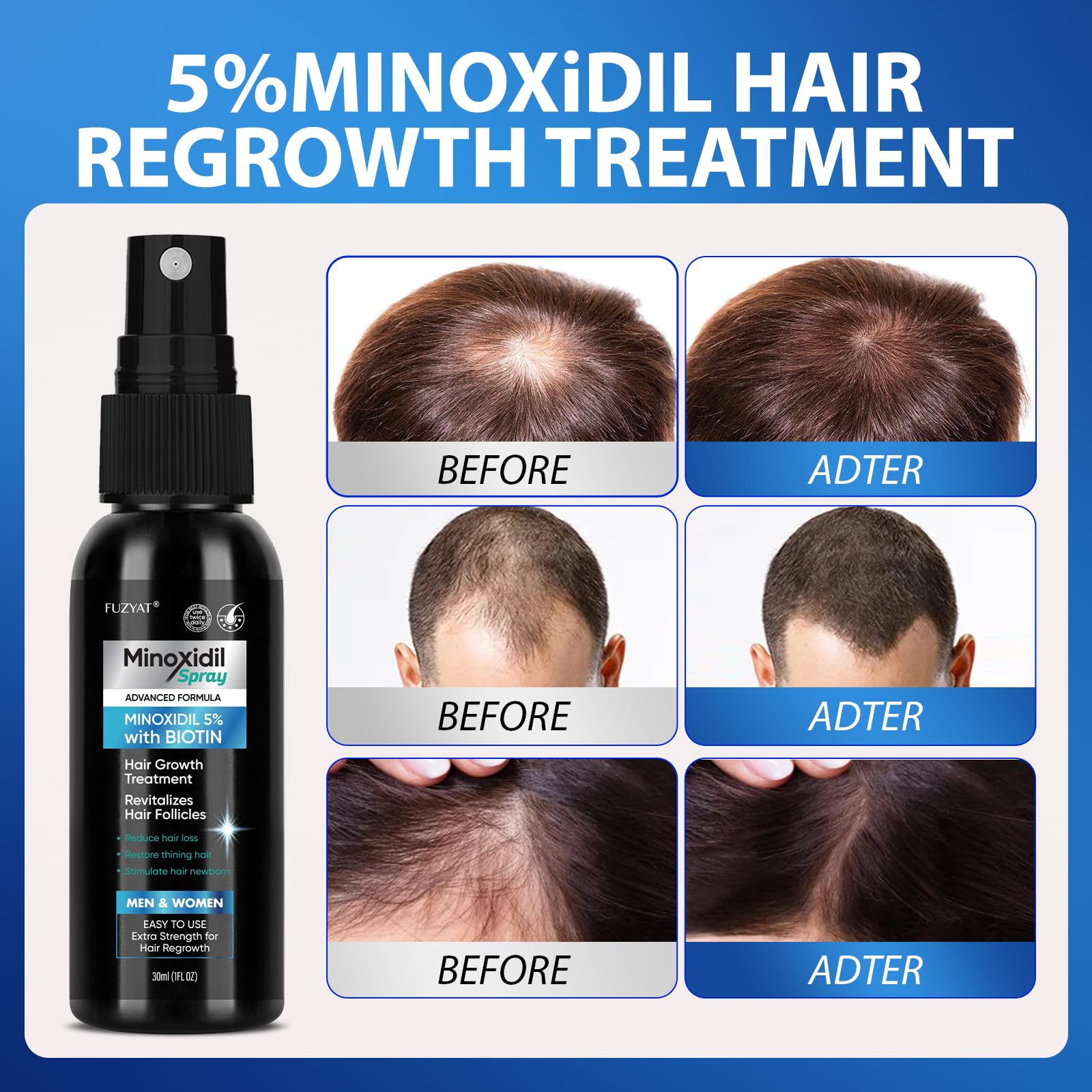 FUZYAT 5% Minoxidil Spray – Biotin-Enhanced Hair Growth for Men & Women, 180ml