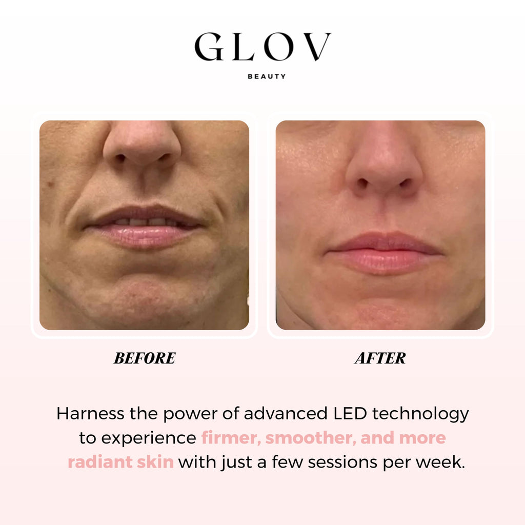 Glov Beauty LED Face Mask – Red Light Therapy for Firmer, Smoother Skin