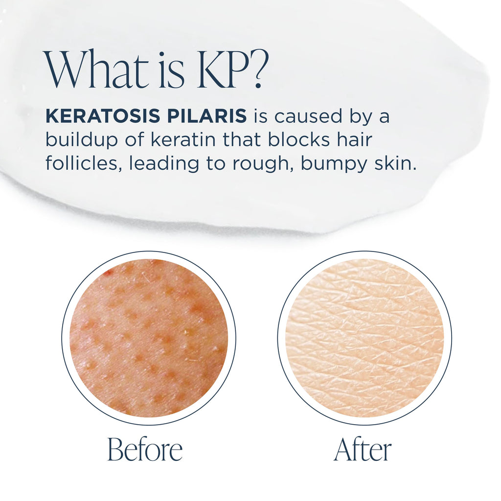Glytone KP Kit – Exfoliating Body Wash, Glycolic Acid Lotion & Shower Pouf for Keratosis Pilaris