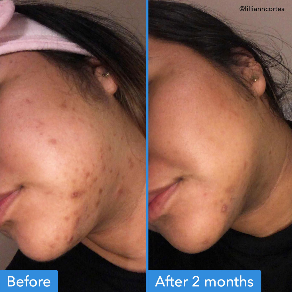 Good Molecules Discoloration Correcting Serum Pack 3 – 75 ml | Tranexamic Acid + Niacinamide