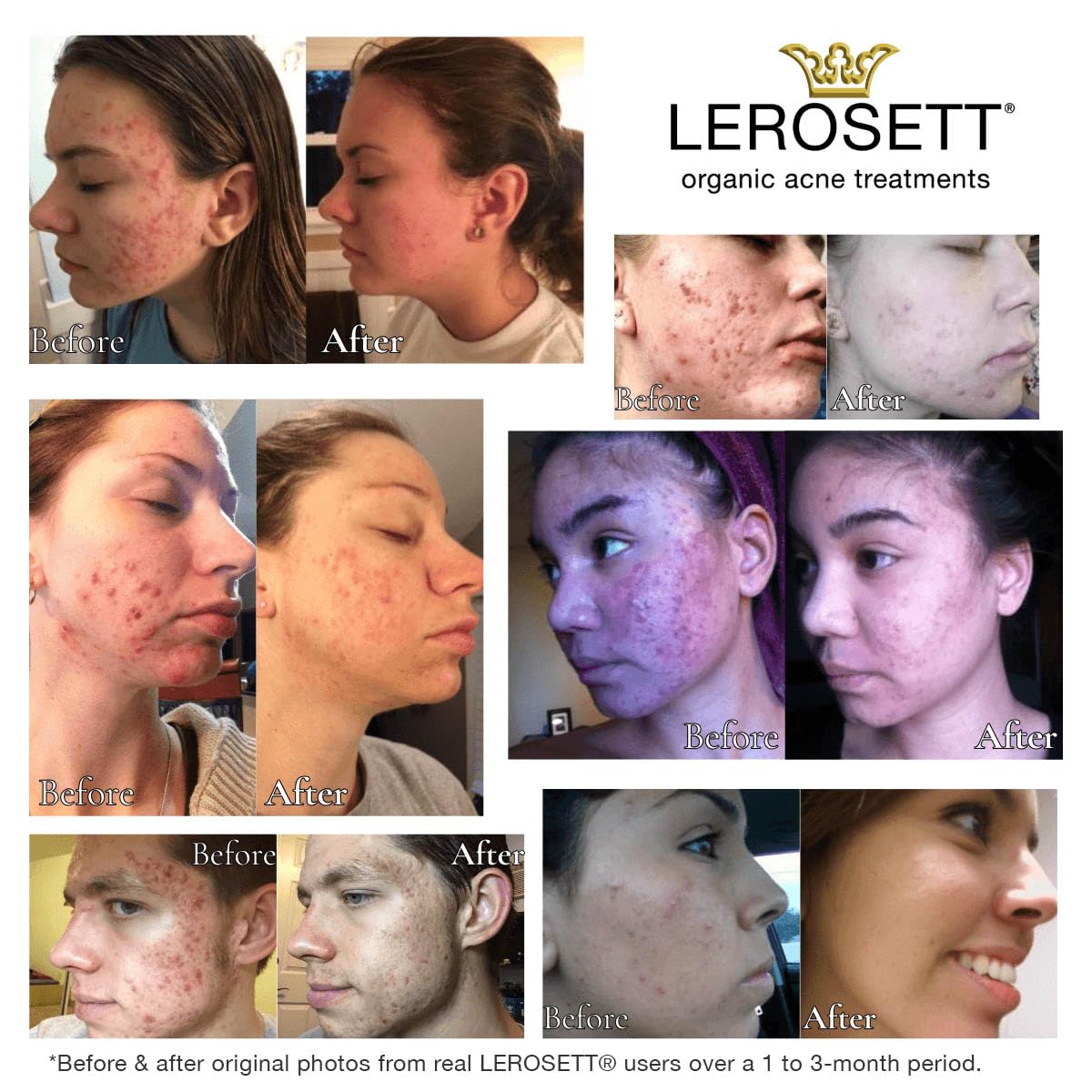 LEROSETT Botanical Acne Cleanser – 2% Salicylic Acid, 50% Aloe, Vegan, All Skin Types | 6.7 oz | Gunilla Of Sweden