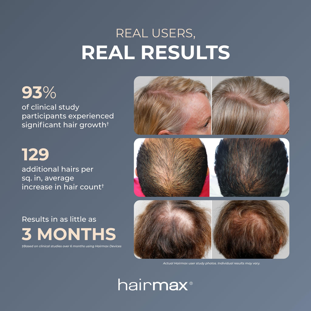 HairMax Laser Band 41 – FDA-Cleared Red Light Therapy Device for At-Home Hair Growth