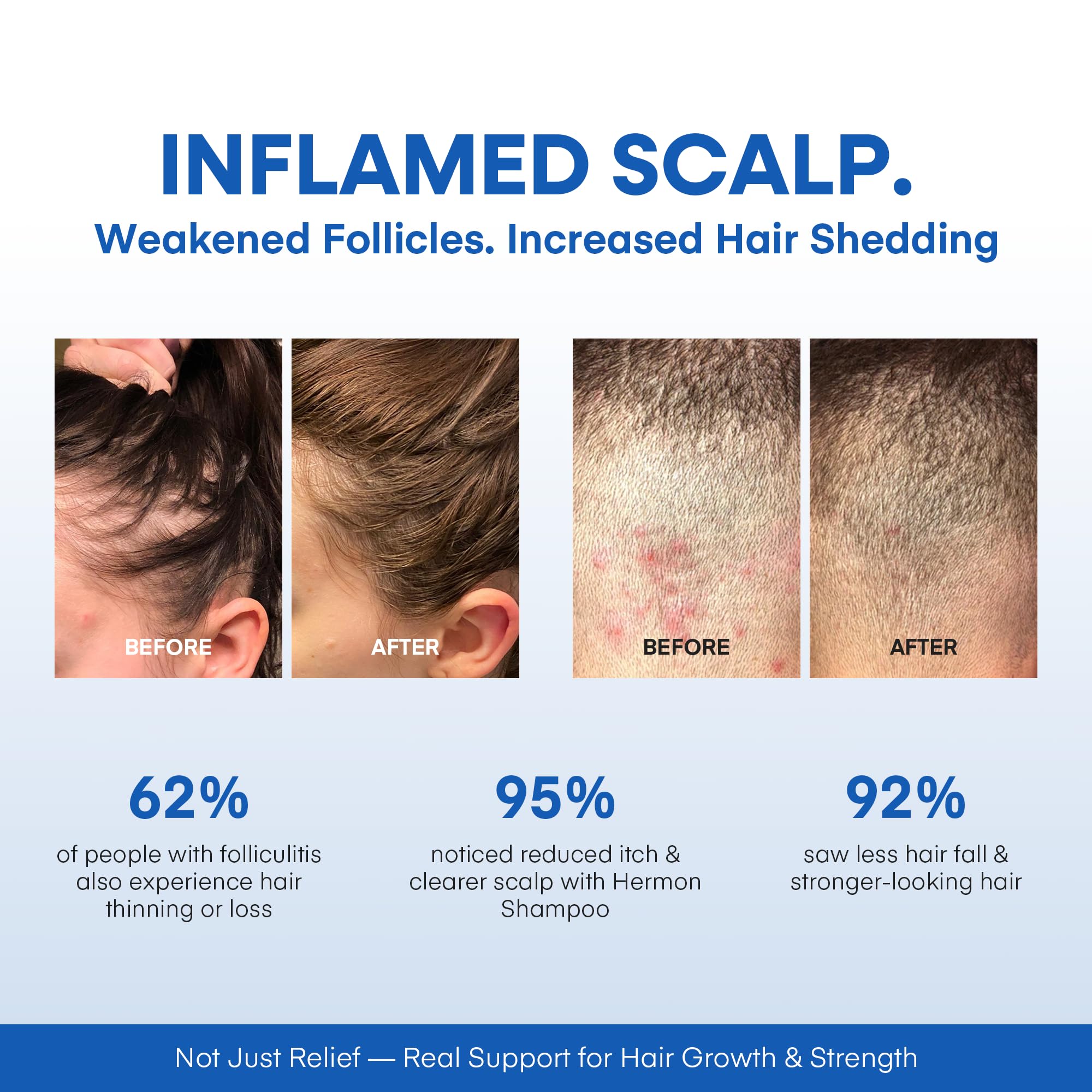 Hermon Folliculitis Treatment Kit: Shampoo & Tea Tree Soap for Scalp, Body & Intimate Areas