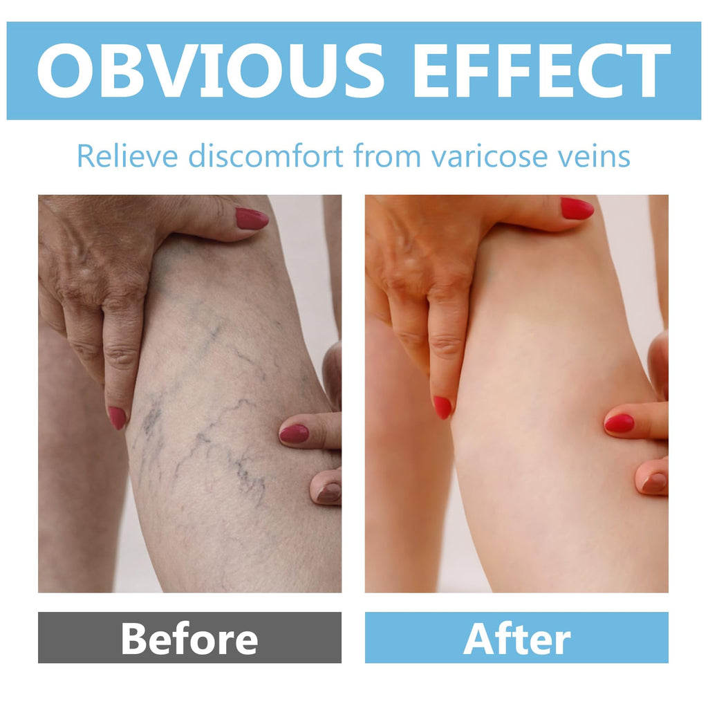 ITECFREELY Varicose Veins Cream – Improve Circulation & Leg Comfort