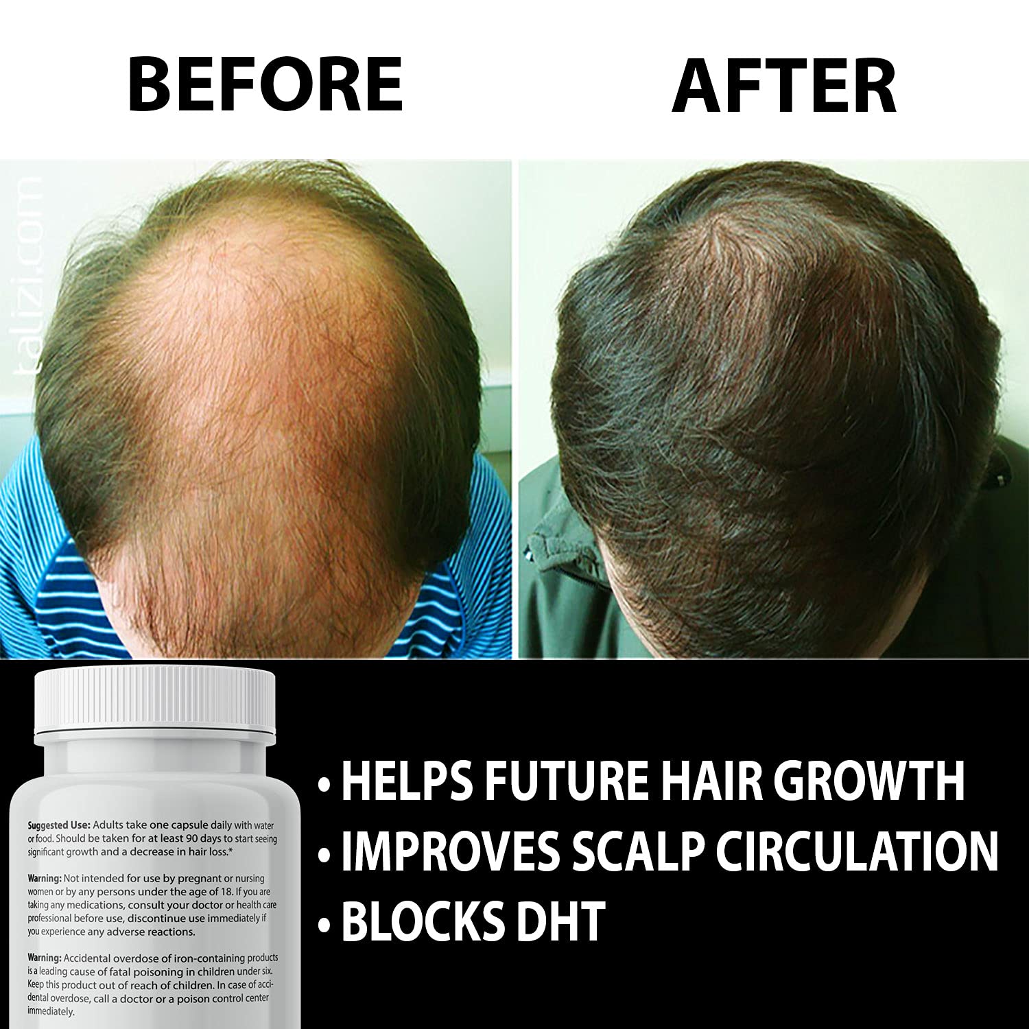 Finanutride | Natural DHT Blocker & Hair Growth Capsules | IXYAY RESEARCH