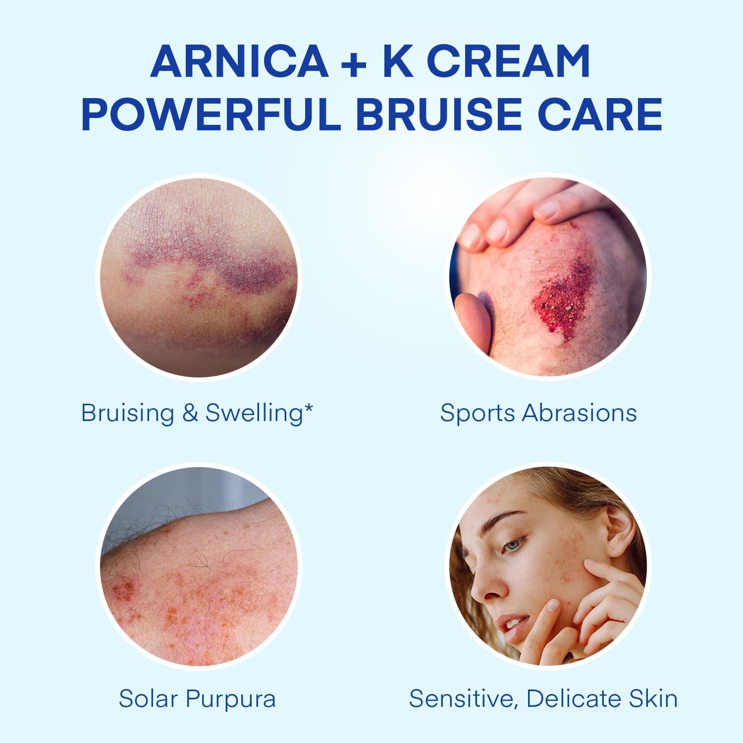Jardient Arnica Bruise Cream Extra-Strength – Fast-Acting for Bruises on Thin Skin (4 oz)