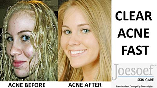 JOESOEF SKIN CARE Sulfur Soap for Acne – Pharmaceutical Grade, Dermatologist Approved 100g