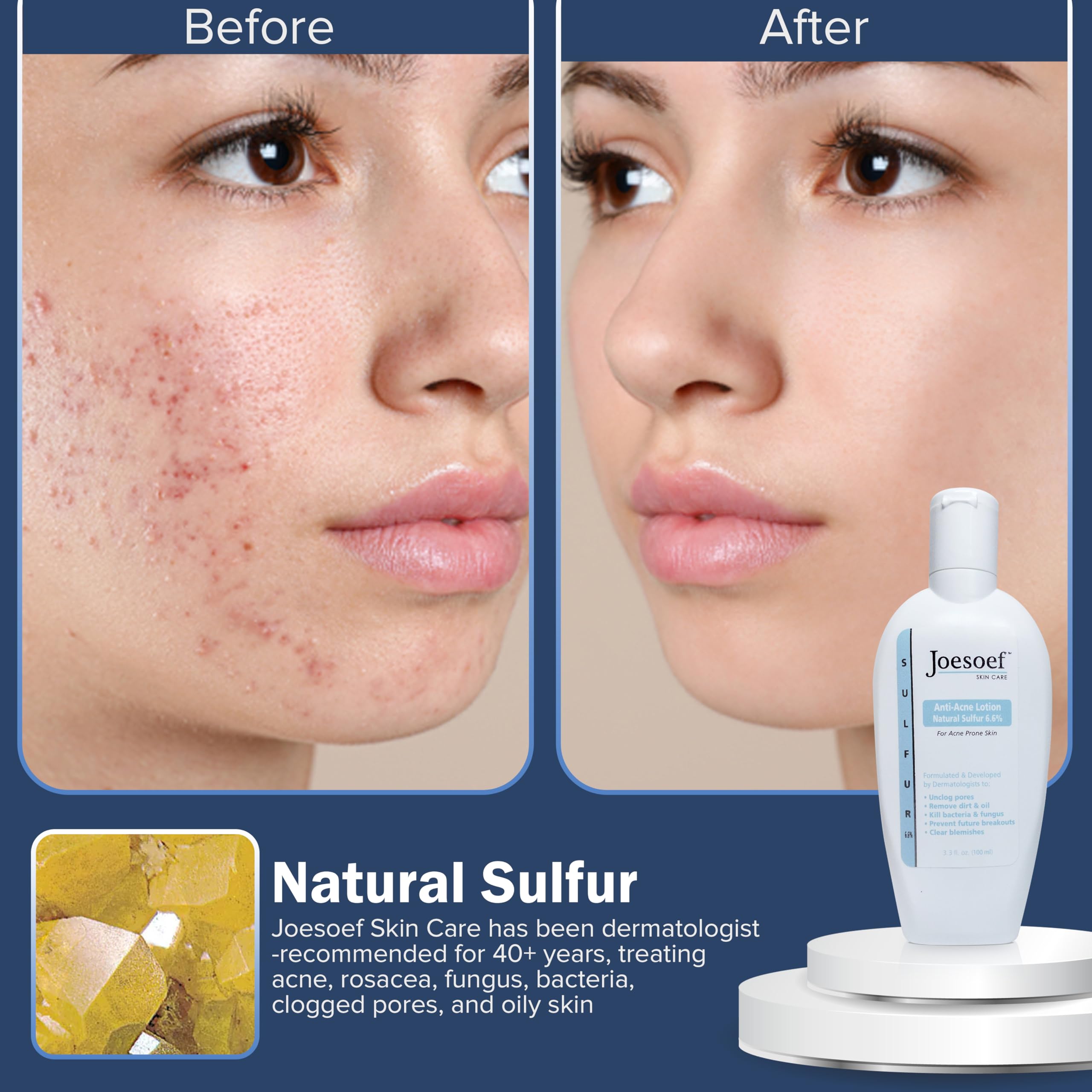 JOESOEF SKIN CARE Sulfur Soap for Acne – Dermatologist-Approved, Pharmaceutical-Grade, Rosacea-Safe (2-Pack)