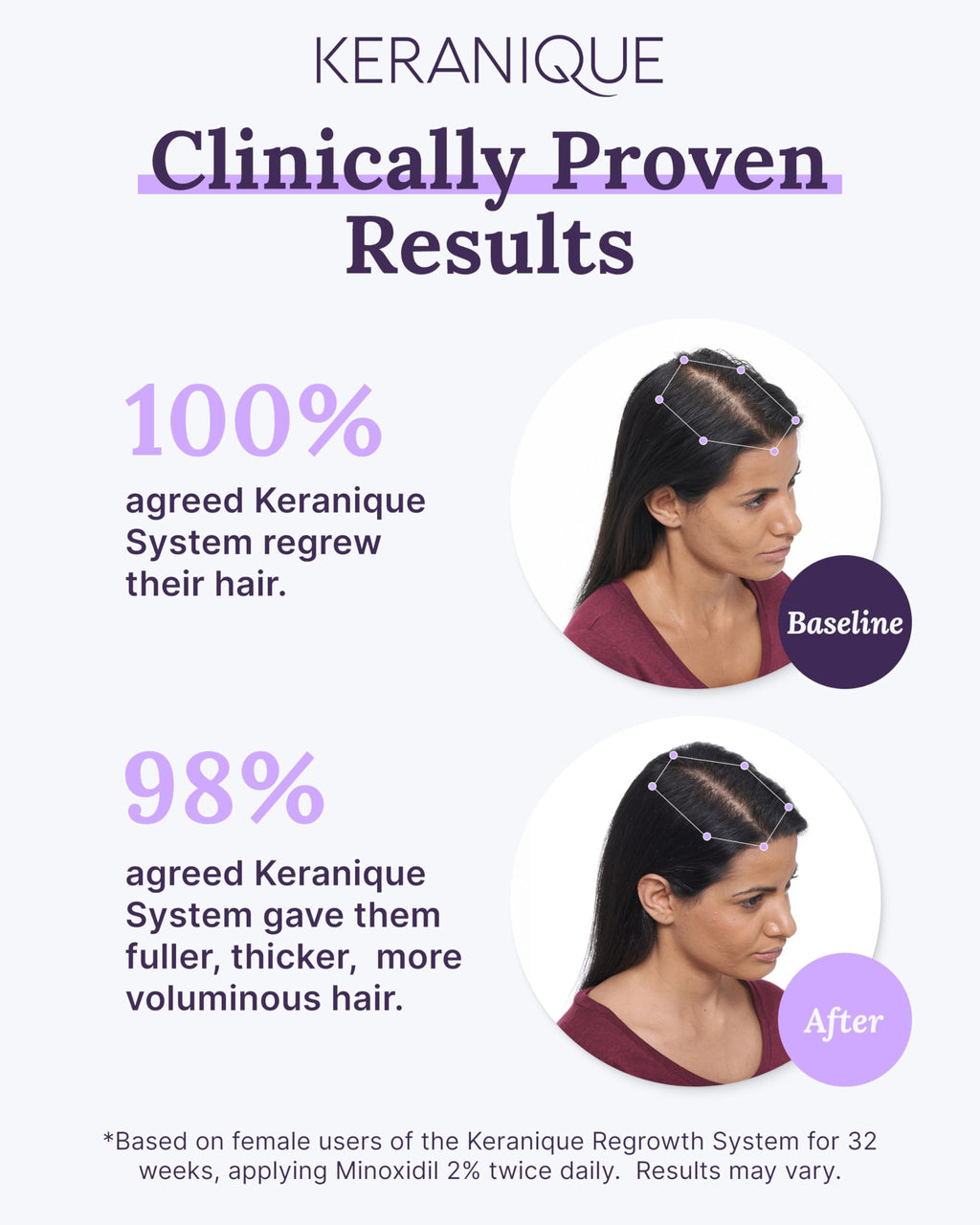 Keranique 5% Minoxidil Foam for Women – Hair Regrowth, NutriGrow Hydration & 4-Month Supply
