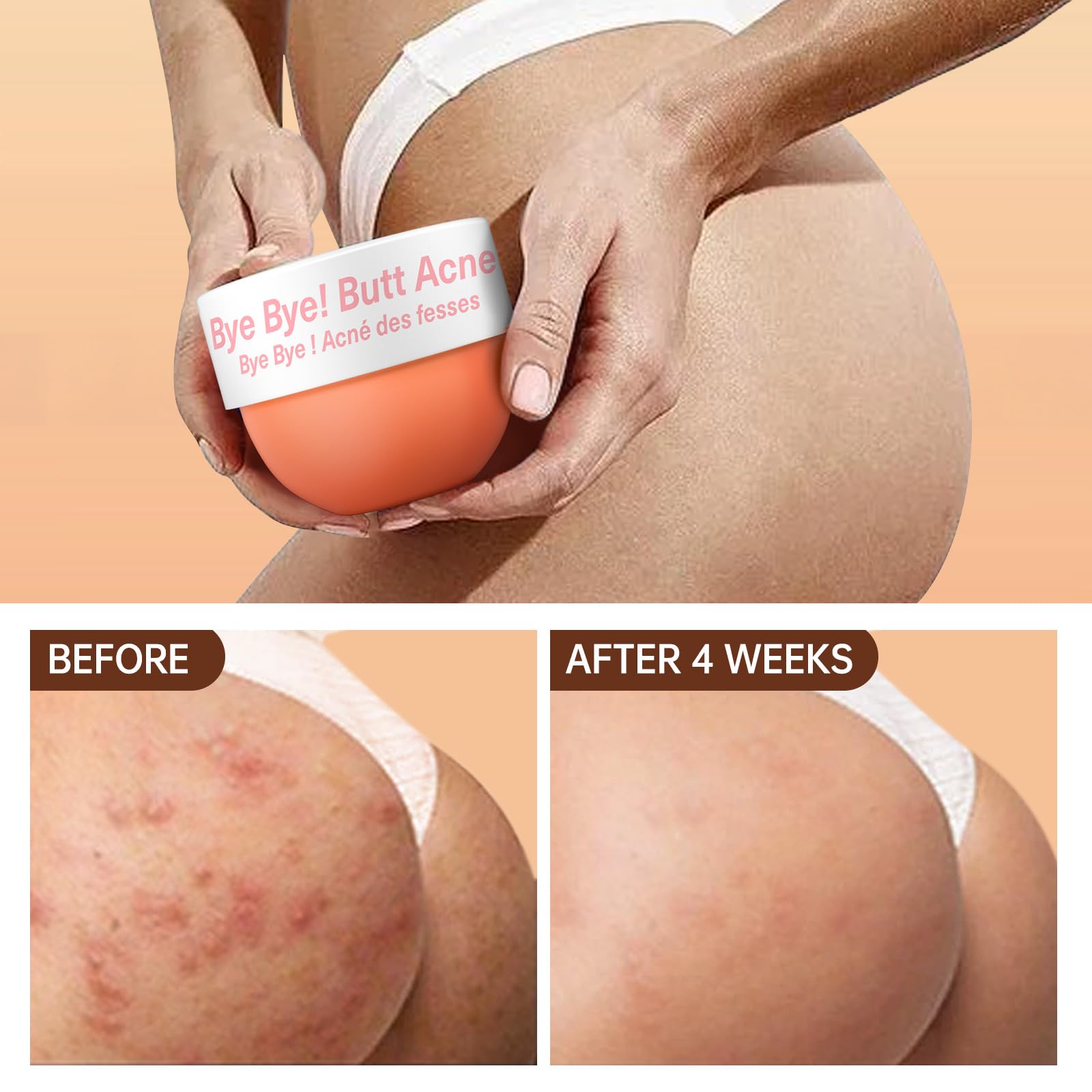 LA.PERSONAL Butt Acne Clearing Treatment – Body Cream for Back, Buttocks, Thigh & Chest