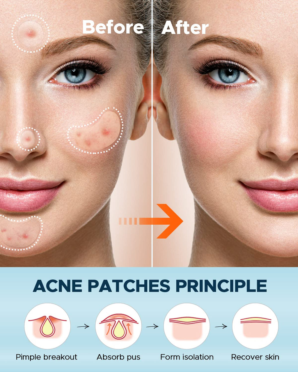 LitBear Large Acne Pimple Patches – 100 Patches, 6 Sizes, Tea Tree & Calendula, Hydrocolloid for Face & Body