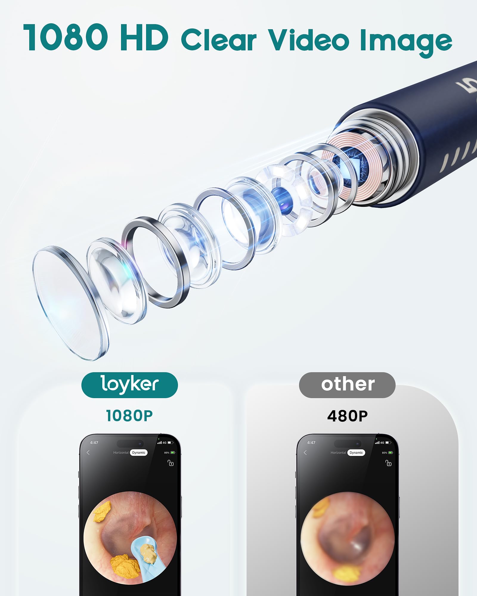 Loyker Ear Wax Removal Kit with 1080P Camera – Visual Ear Cleaner (12 Tips)