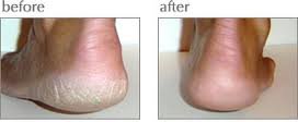 Luxuriant Cracked Heel Repair – The ORIGINAL Twin Pack (2x2.5oz) Dry Heel Cream