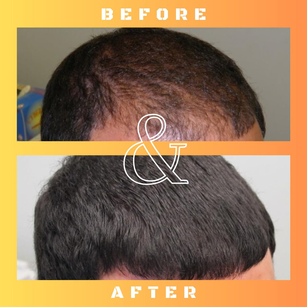 Mane Regain RU58841 5% Solution (50 mg/ml) – DHT Blocker for Hair Loss, 30ml