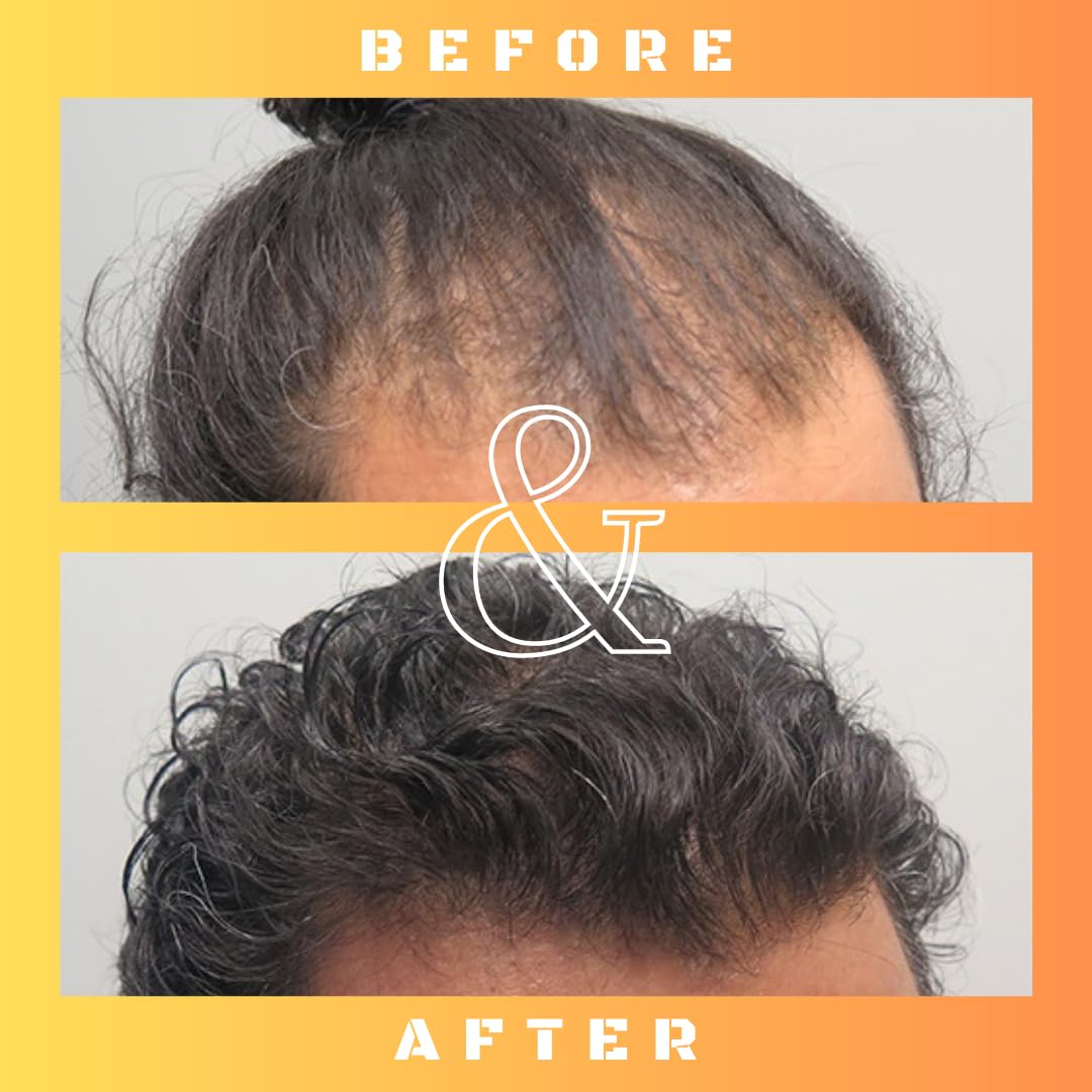 Mane Regain RU58841 5% Solution (50 mg/ml) – DHT Blocker for Hair Loss, 30ml