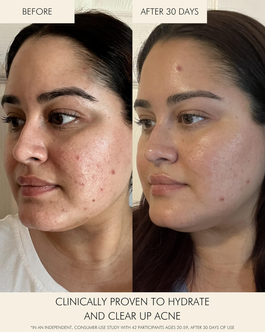 MARA Clear Skin Mineral Milk Hydrating Acne Treatment with Niacinamide + Copper | BHA Serum for All Skin Types (1 oz / 30 ml)