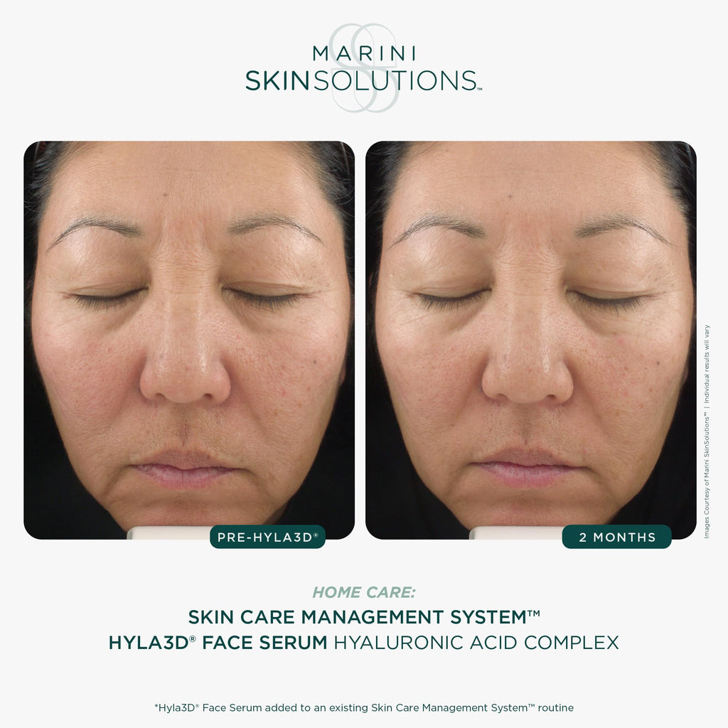 Marini SkinSolutions Hyla3D Face Serum – Patented HA Hydration for All Skin Types