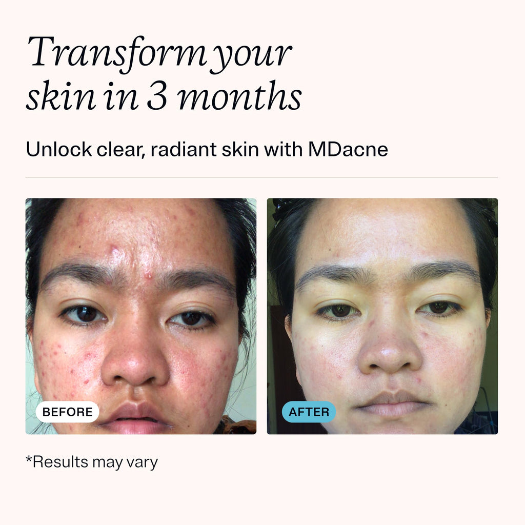MDacne 3 Step Acne Treatment Kit – Benzoyl Peroxide 2.5%, Salicylic Cleanser, Niacinamide Moisturizer