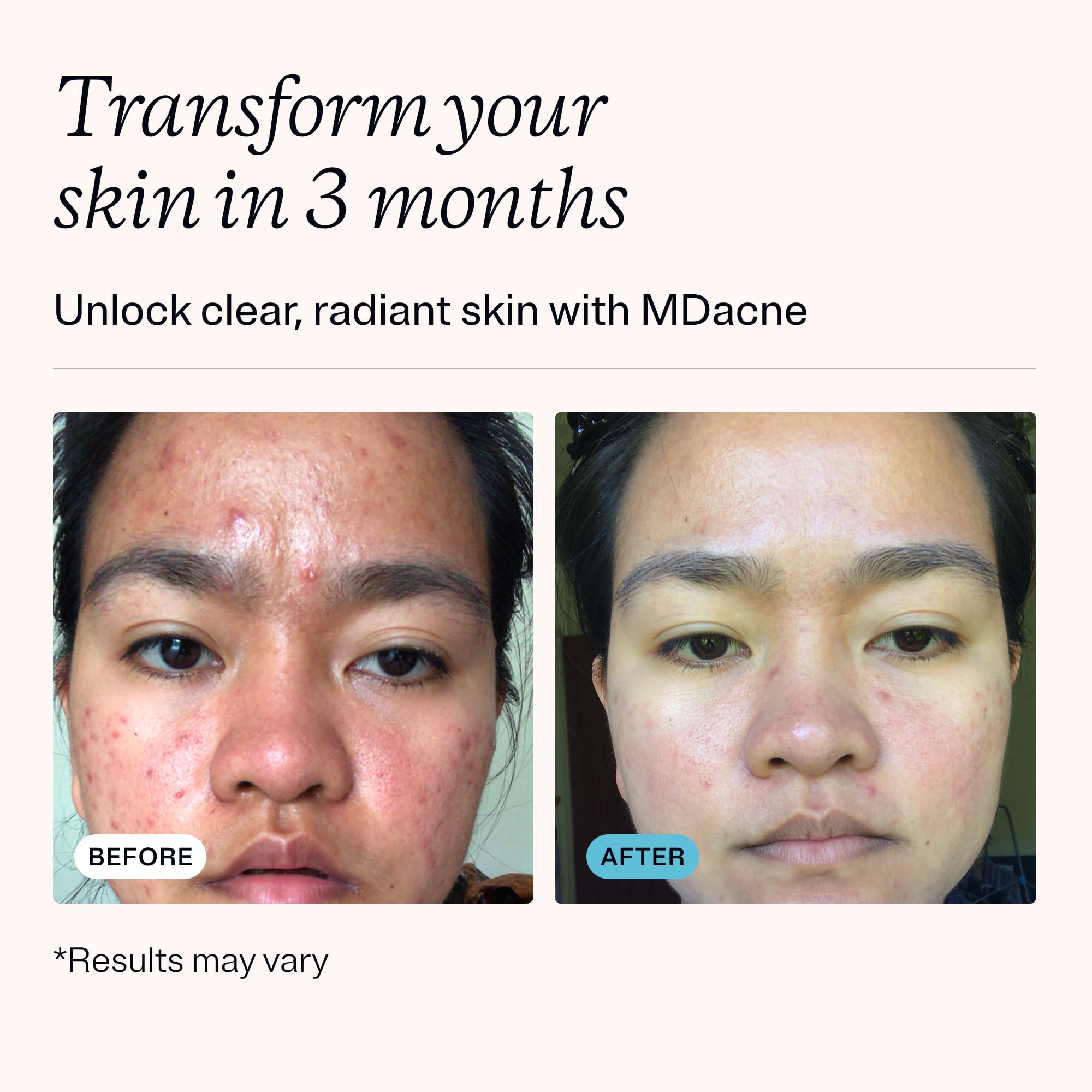 MDacne 3 Step Acne Treatment Kit – Benzoyl Peroxide 2.5%, Salicylic Cleanser, Niacinamide Moisturizer