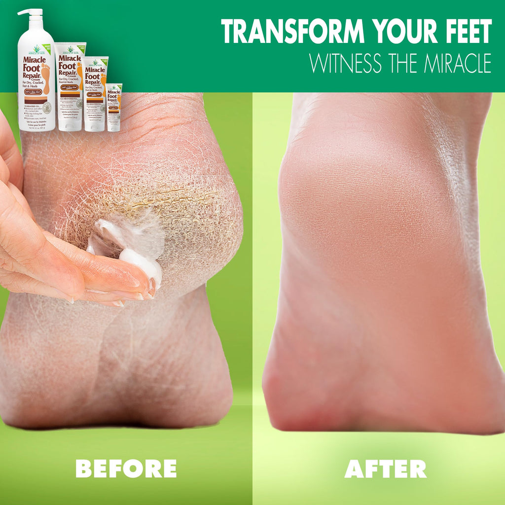 Miracle Foot Repair Cream (8 oz / 3-Pack) – 60% Ultra Aloe for Dry, Cracked Heels