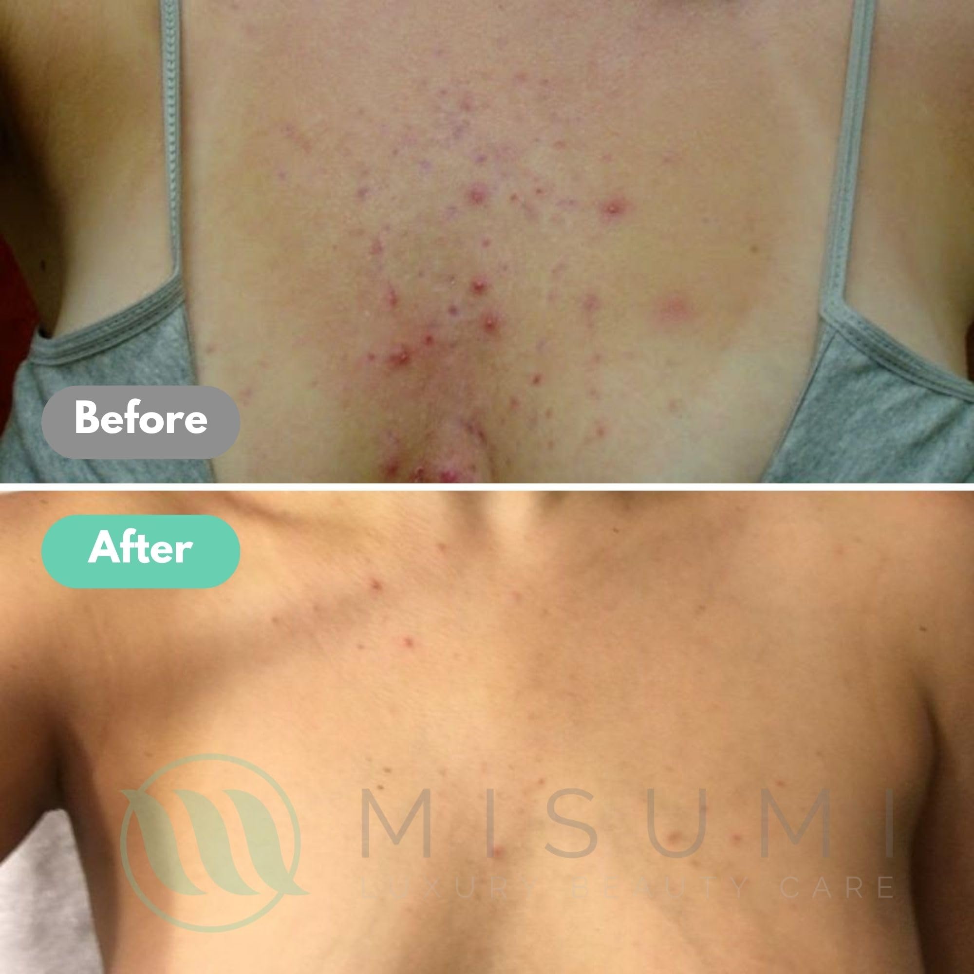 Misumi Acne Body Wash 120ml – KP & Bacne Treatment with Salicylic & Glycolic Acids