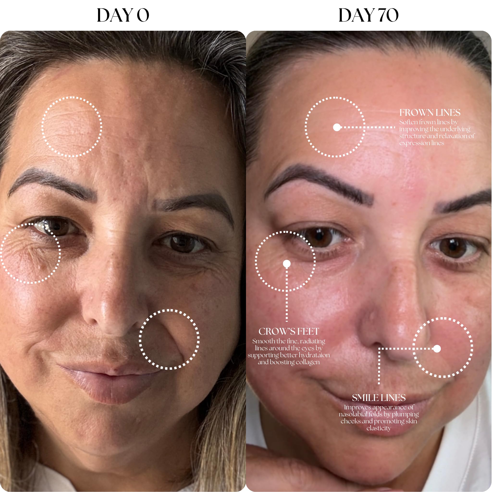 Mon Lumière Micro-Infusion System – 0.25mm Gold Derma Stamp with PDRN & Peptides – At-Home Facial Starter Kit