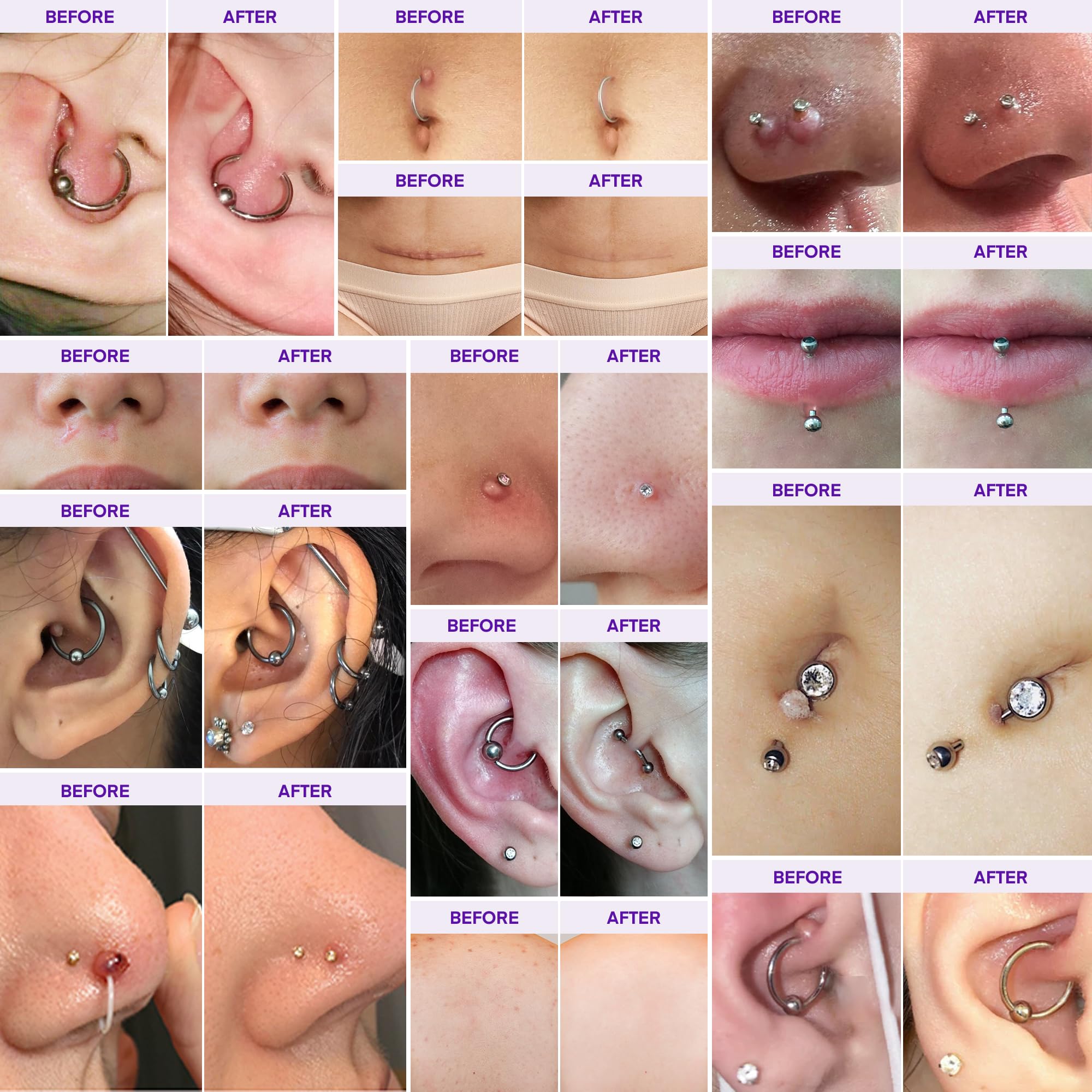 MURASAKI BEAUTY Piercing & Keloid Bump Solution Oil & Gel Kit – 2 Pack