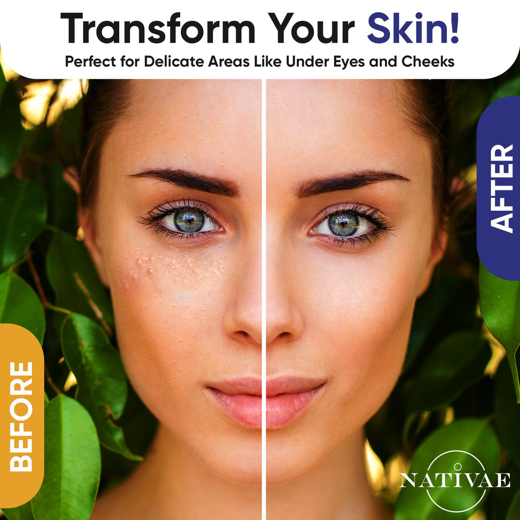 Nativae Milia Remover — Eye & Face Milia Spot Treatment with Salicylic Acid & Tea Tree