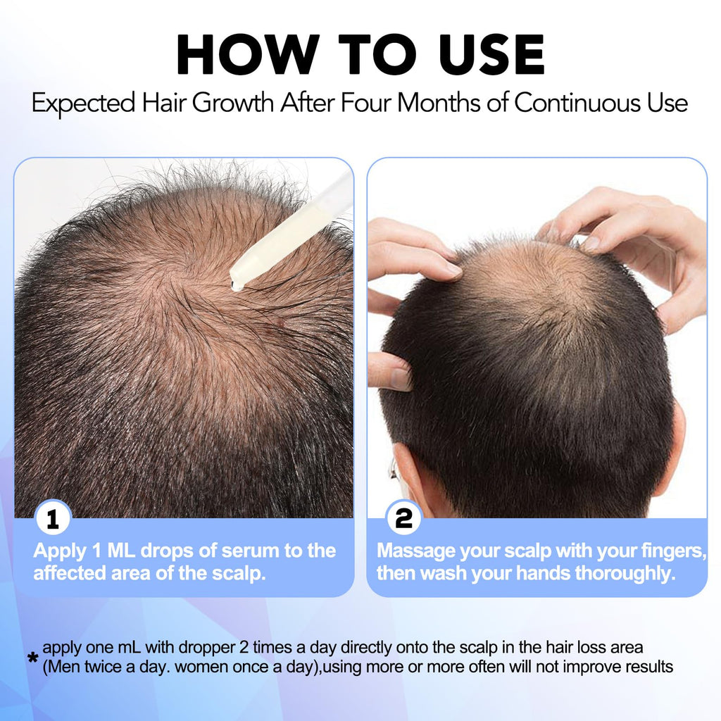 Nature Ziran Minoxidil 5% Extra Strength Hair Regrowth for Men & Women – Dropper Applicator Included