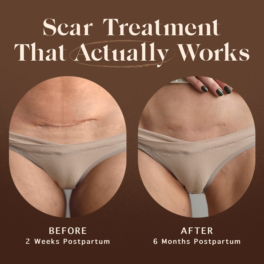 Nemah Restorative Scar Treatment - C-Section Recovery, Postpartum Scar Care - Vegan & Cruelty-Free - 1 oz
