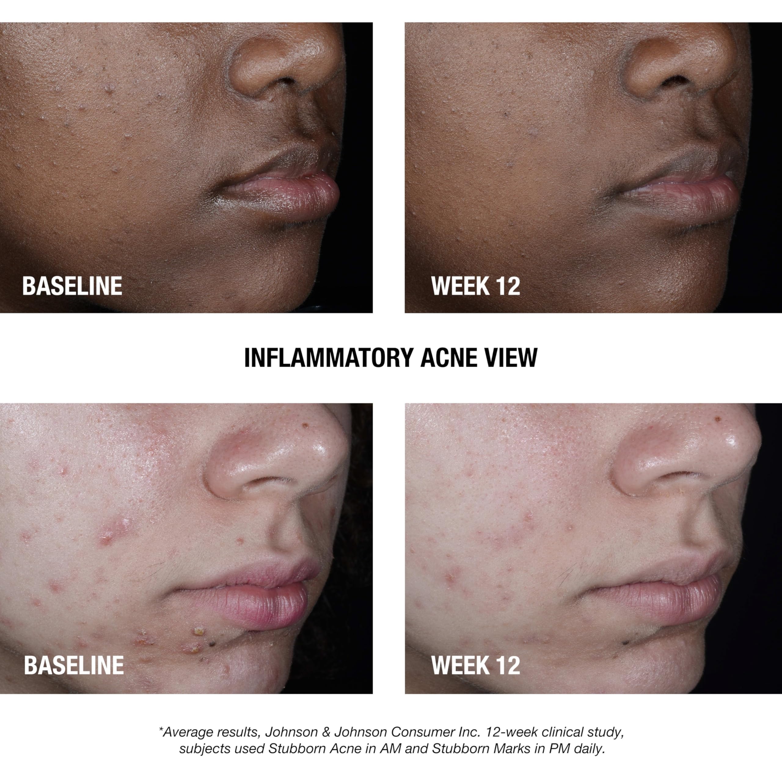 Neutrogena Stubborn Acne AM Treatment | 2.5% Benzoyl Peroxide, Oil-Free