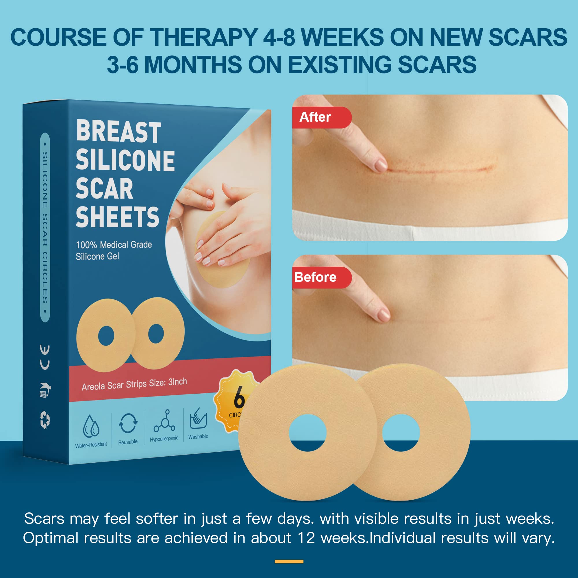Nubical 6-Pack Silicone Breast Scar Sheets Tape – Round Blue Post-Surgery Scar Care
