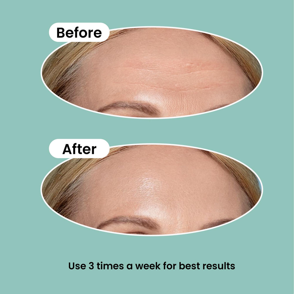NURIVE Advanced Wrinkle Patches 20ct – Forehead, Smile & Frown Lines | Retinol + Collagen