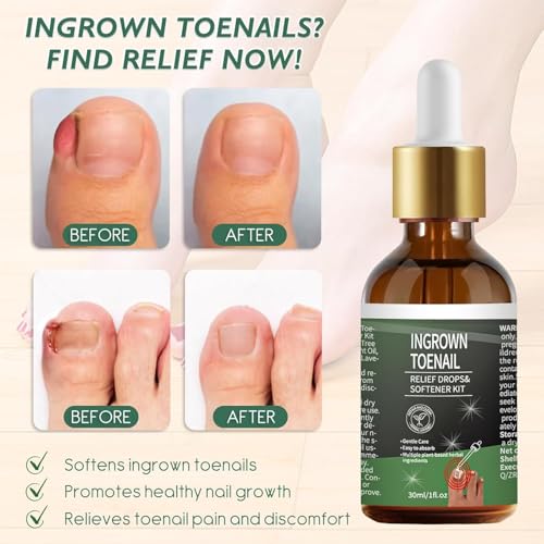 NWAKRD Ingrown Toenail Treatment Kit – 30ml Softening & Conditioning with Silicone Gel Toe Caps
