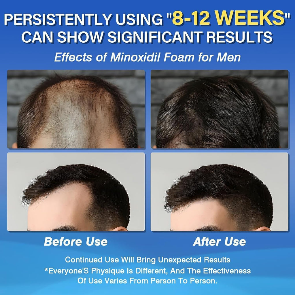 Olassubd Minoxidil 5% Foam for Men – Hair Growth Solution