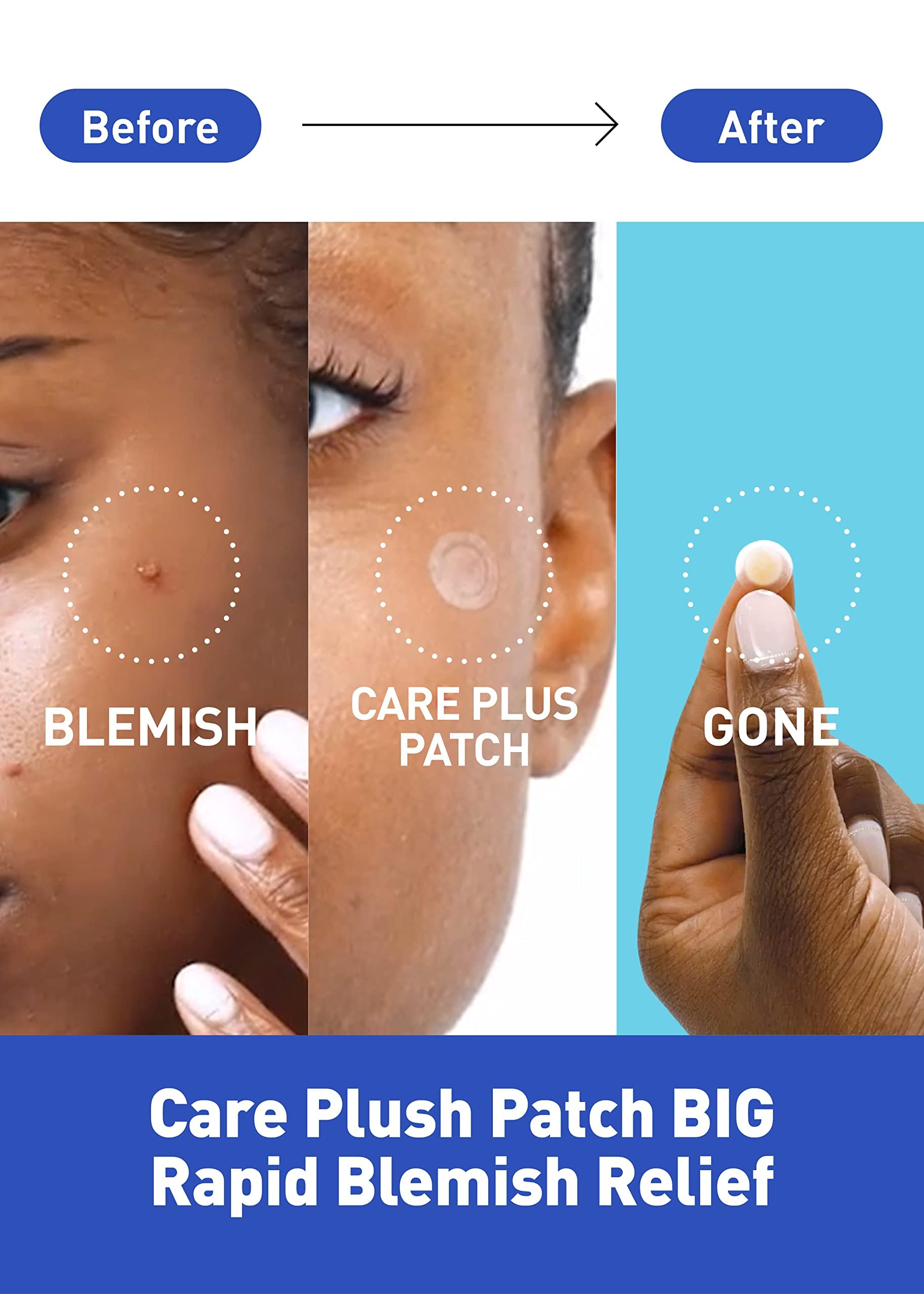 OLIVE YOUNG Care Plus Spot Patch – Hydrocolloid Acne Patches, 510 Count (Pack of 5)