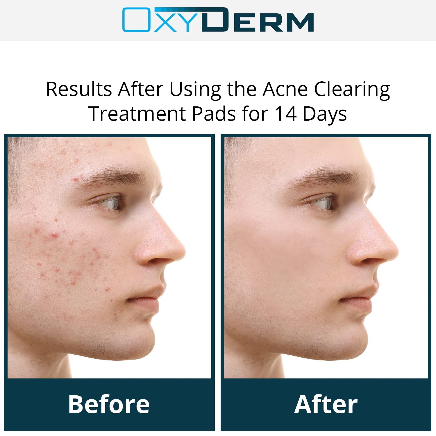 OxyDerm Acne Treatment Pads – Clear Pores, Reduce Blemishes & Breakouts | 60 Count