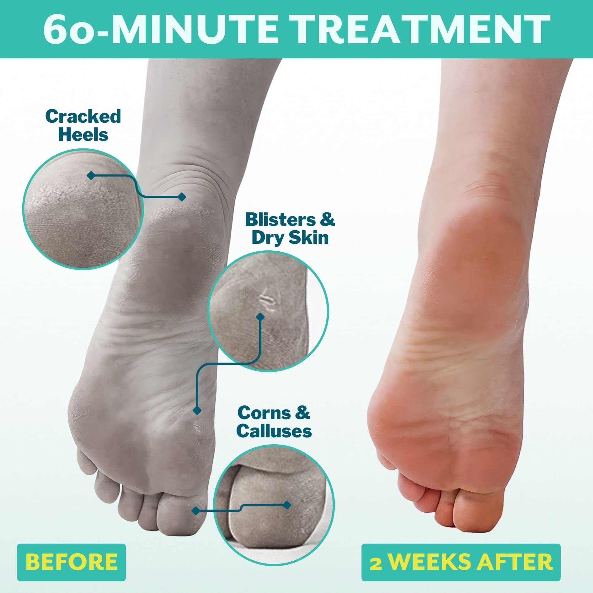 Patchology PoshPeel Pedi Cure Foot Peel Mask & Booties – Deep Exfoliation (Pack of 2)