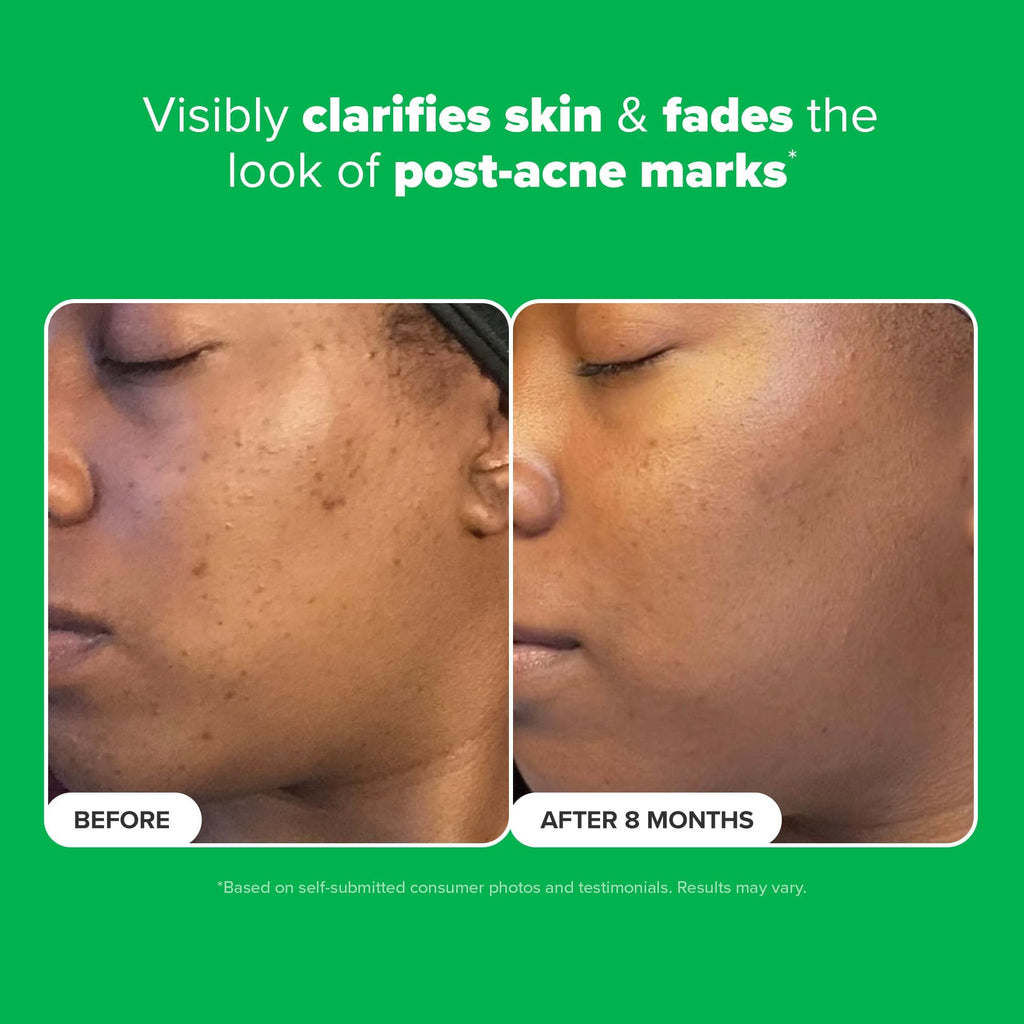 Paula's Choice BOOST 10% Azelaic Acid Booster Cream-Gel – Oil-Free Serum with Salicylic Acid